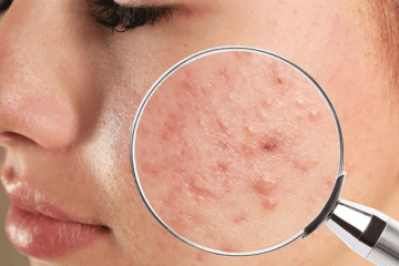 Acne treatment - Eryna Aesthetic Clinic in KL