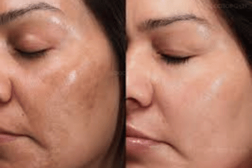 Melasma & Pigmentation - Eryna Aesthetic Center in KL